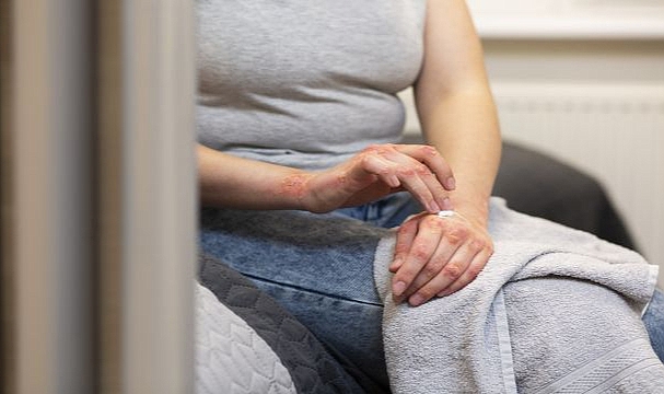 Bu hastalık kadınlarda 9 kat fazla görülüyor